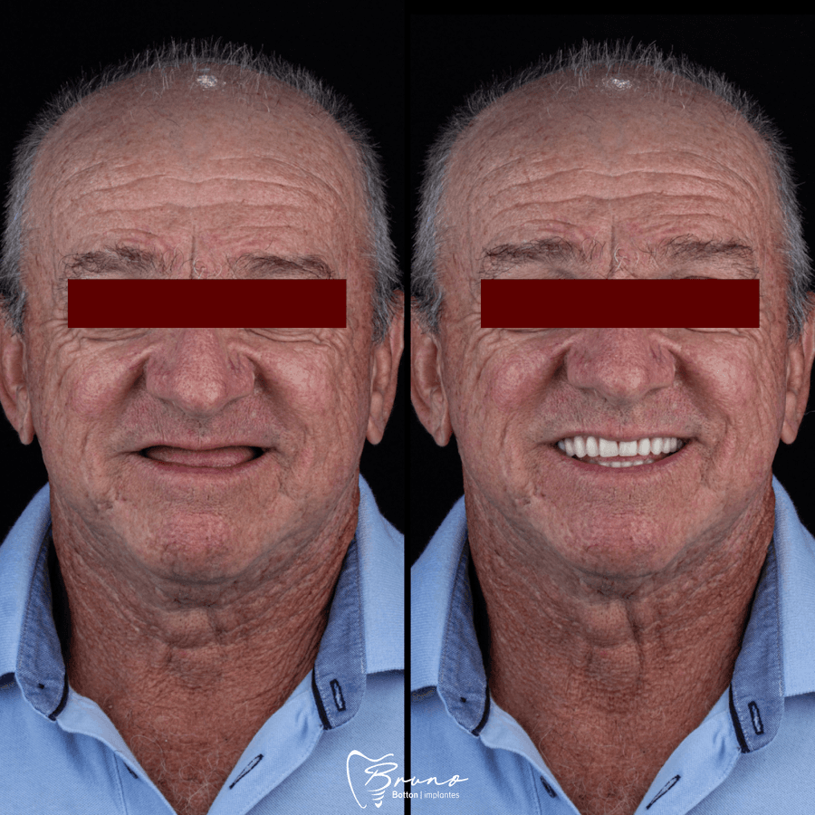 Depois — Resultado real